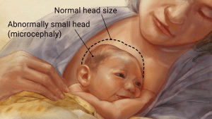 microcephaly